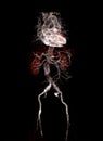 CTA abdominal aorta 3D rendering image