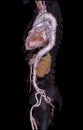 CTA abdominal aorta 3D rendering image on transparent skeletal