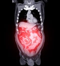 CTA of Aorta and Major Branches:.A comprehensive CTA scan showing the aorta and its major branches, providing clear visualization