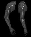 CTA brachial artery or CT scan of upper extremity 3D rendering image