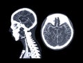 CTA brain or CT angiography of the brain .