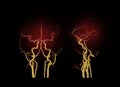 CTA BRAIN or CT angiography of the brain 3D Rendering image AP and Lateral view showing cerebral artery