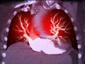 CTA Chest  or CTPA with contrast media 3D rendering  for diagnostic Pulmonary embolism (PE Royalty Free Stock Photo