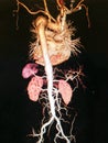 CTA computed tomography angiographphy3D take photo from film x-ray of whole aorta