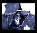 CTA Coronary artery 3D MIP.