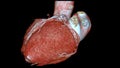 CTA coronary artery 3D rendering is a diagnostic imaging technique capturing detailed visuals of the heart's blood vessels in