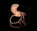 CTA Coronary artery 3D rendering image