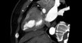 CTA Coronary artery vertival long axis view for diagnosis of vessel coronary artery stenosis