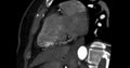 CTA Coronary artery vertival long axis view for diagnosis of vessel coronary artery stenosis