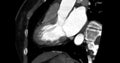 CTA Coronary artery vertival long axis view for diagnosis of vessel coronary artery stenosis