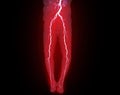 CTA femoral artery run off image of femoral artery for diagnosis Acute or Chronic Peripheral Arterial Disease