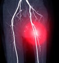 CTA femoral artery run off image of femoral artery .