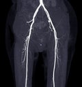 CTA femoral artery run off image of femoral artery