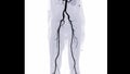 CTA femoral artery run off image of femoral artery for diagnostic Acute or Chronic Peripheral Arterial Disease