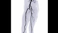 CTA femoral artery run off image of femoral artery for diagnostic Acute or Chronic Peripheral Arterial Disease