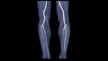 CTA femoral artery run off image of femoral artery for diagnostic Acute or Chronic Peripheral Arterial Disease