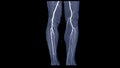 CTA femoral artery run off image of femoral artery for diagnostic Acute or Chronic Peripheral Arterial Disease