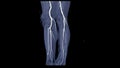 CTA femoral artery run off image of femoral artery for diagnostic Acute or Chronic Peripheral Arterial Disease