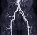 CTA femoral artery run off image of femoral artery .