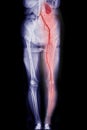 CTA femoral artery run off showing femoral artery for diagnostic Acute or Chronic Peripheral Arterial Disease