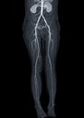 CTA femoral artery run off showing femoral artery for diagnostic Acute or Chronic Peripheral Arterial Disease