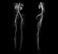CTA femoral artery run off showing femoral artery for diagnostic Acute or Chronic Peripheral Arterial Disease
