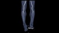 CTA femoral artery run off showing femoral artery for diagnostic Acute or Chronic Peripheral Arterial Disease