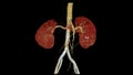 CTA Renal artery 3D is a medical imaging procedure using CT scans to examine the renal arteries It provides detailed images of the