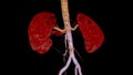 CTA Renal artery 3D is a medical imaging procedure using CT scans to examine the renal arteries It provides detailed images of the