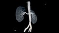 CTA Renal artery 3D is a medical imaging procedure using CT scans to examine the renal arteries It provides detailed images of the