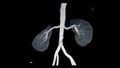 CTA Renal artery 3D is a medical imaging procedure using CT scans to examine the renal arteries It provides detailed images of the