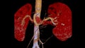 CTA Renal artery 3D is a medical imaging procedure using CT scans to examine the renal arteries It provides detailed images of the