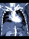 CTA thoracic aorta 3D MIP.