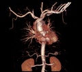 CTA thoracic aorta 3D rendering image