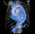 CTA thoracic aorta 3D rendering image .