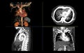 CTA thoracic aorta 3D rendering image