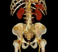 CTA whole aorta with Abdominal aorta stent graft compare 3D rendering image