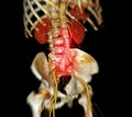 CTA whole aorta with Abdominal aorta stent graft compare 3D rendering image