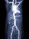 CTA whole aorta 3D rendering