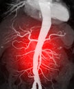 CTA whole aorta 3D rendering