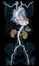 CTA Whole aorta 3D rendering image .