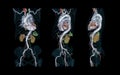 CTA Whole aorta 3D rendering image.