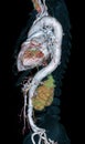 CTA Whole aorta 3D rendering image on black background for detect aortic aneurysm