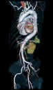 CTA Whole aorta 3D rendering image on black background for detect aortic aneurysm