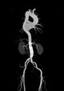 CTA whole aorta 3D rendering image.