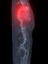 CTA whole aorta with thoracic aorta stent graft .