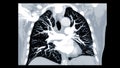 CTPA or CTA pulmonary artery for diagnostic Pulmonary embolism & x28;PE& x29; , lung cancer and covid-19