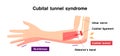 Cubital tunnel syndrome illustration Royalty Free Stock Photo