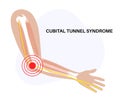 Cubital tunnel syndrome Royalty Free Stock Photo