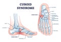 Cuboid syndrome as orthopedic trauma after foot torn injury outline diagram Royalty Free Stock Photo